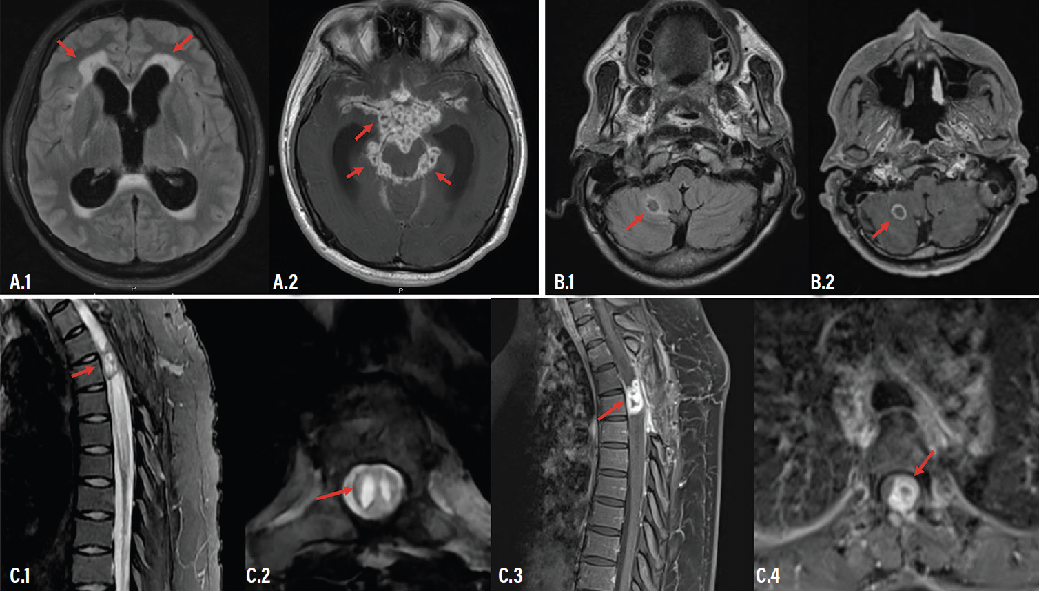 Neurologic Complications of Globally Prevalent Infectious Di