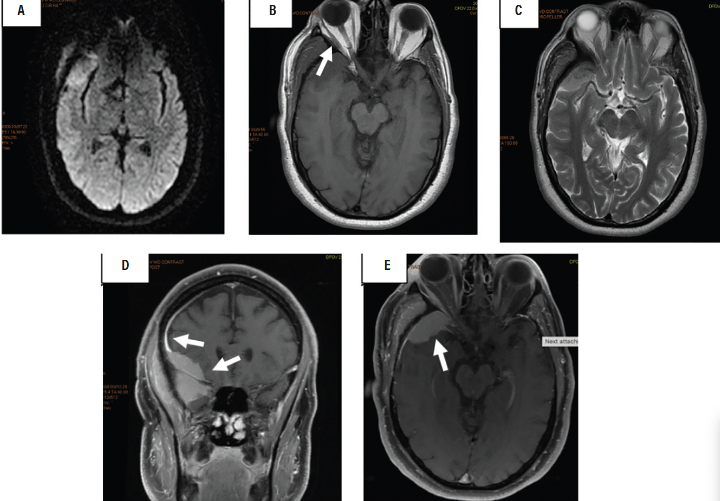 Sphenoid Wing Meningioma Presenting With a Temporal Fossa Ma