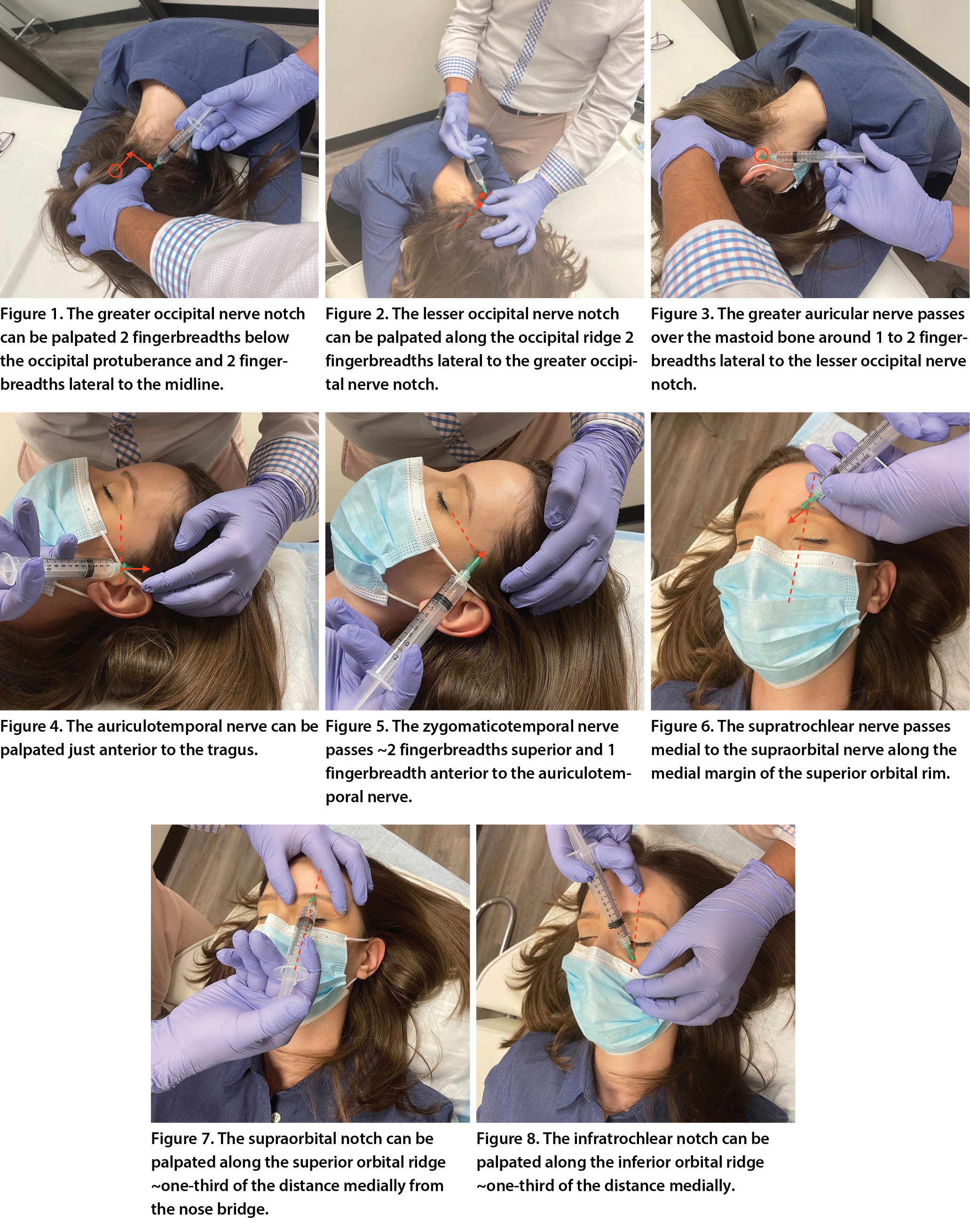 Tpi Injection Neck Non-Botulinum Toxin Injections for Headache—Current Evidence
