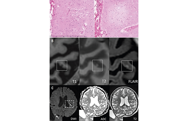 Stroke Snapshot: Cerebral Microinfarcts—Etiology and Clinica