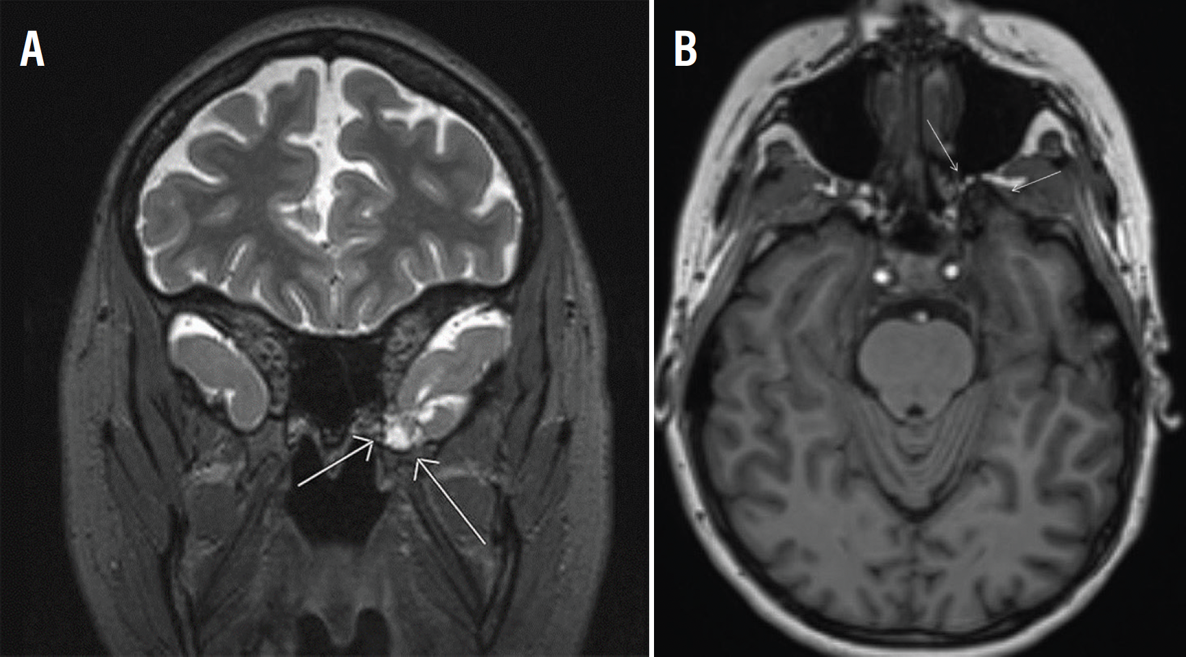 functional neurologic symptom disorder -