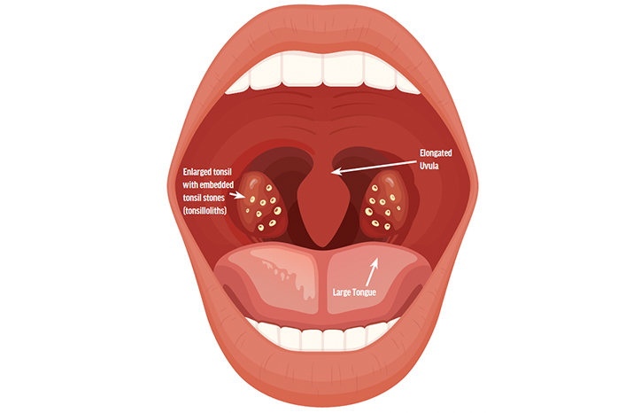 Tonsillectomy for Sleep Apnea & Migraines | Practical Neurology