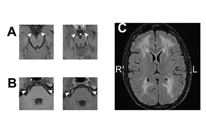 Case Reports: Mitochondrial Neurogastrointestinal Encephalop