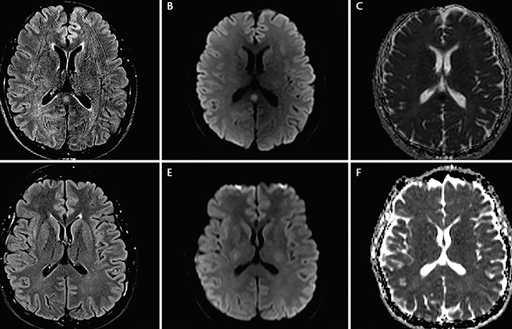 Right Splenium Reversible and Benign Lesions of Splenium of The Corpus Coll