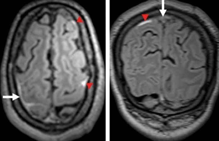 Cerebral Venous Thrombosis Presenting as Recurrent Transient