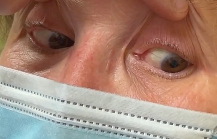 Case Conference: Shaky Vision & Tired Left Eye