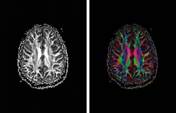 TBI Today: Quantitative Diffusion Tensor Imaging for Assessm