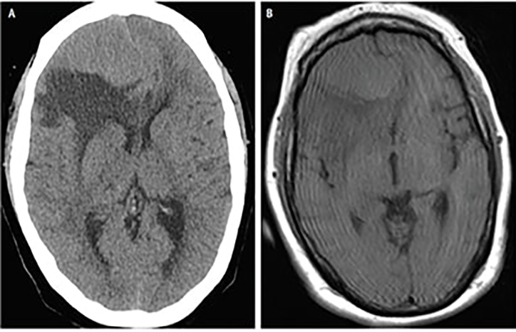 Special Report: Neuro-oncology