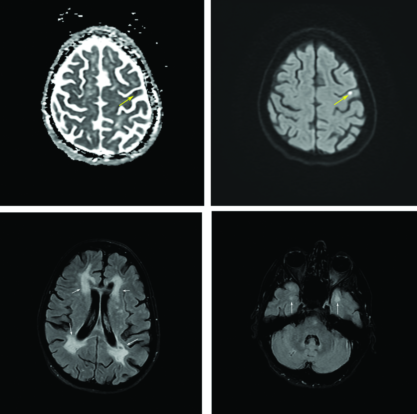 CADASIL Misdiagnosed as Multiple Sclerosis
